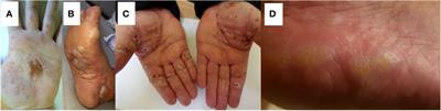 Involvement of palms and soles in patients with autoimmune bullous diseases: a comparative analysis of a diagnostically relevant localization